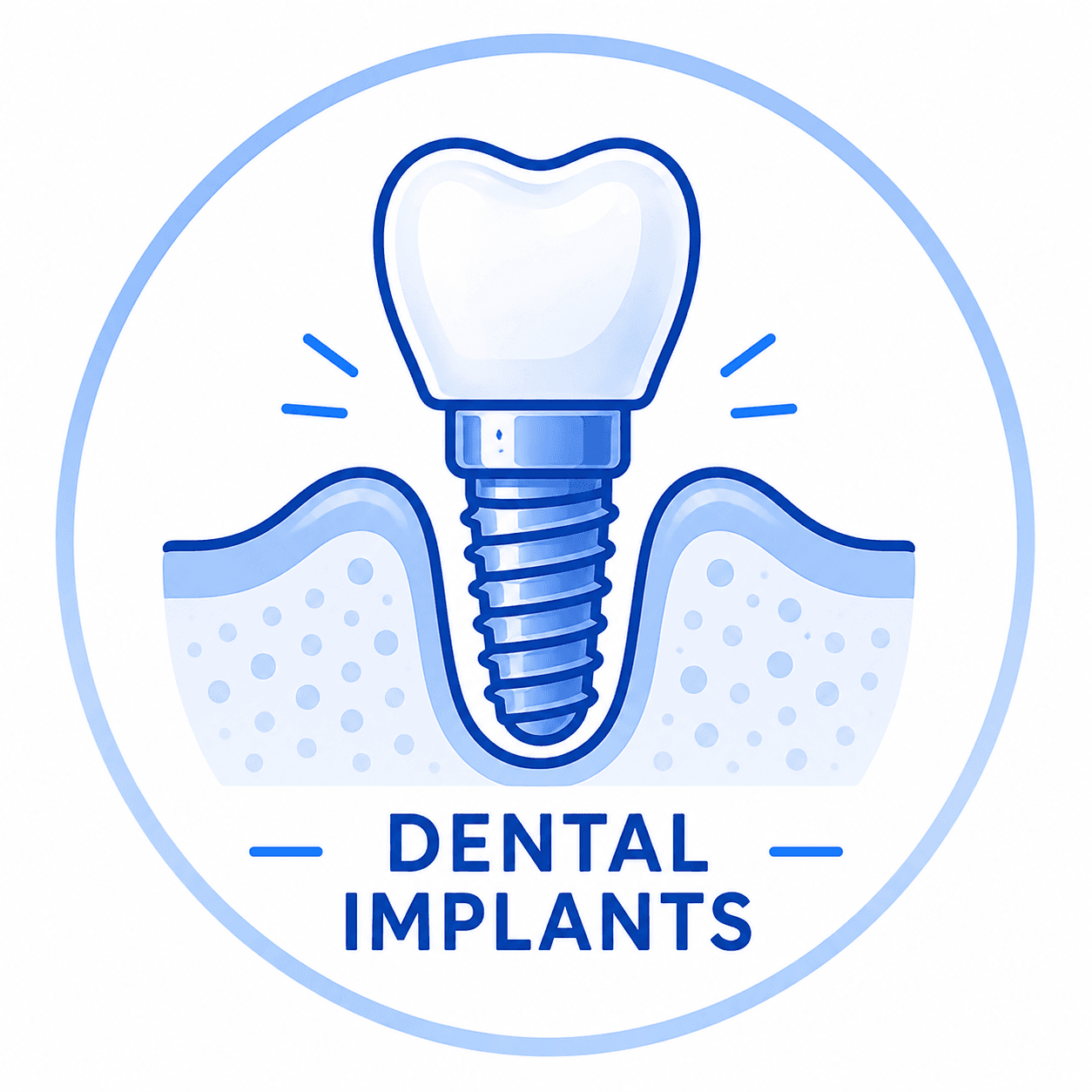 Dental Implants / Full Mouth Implants