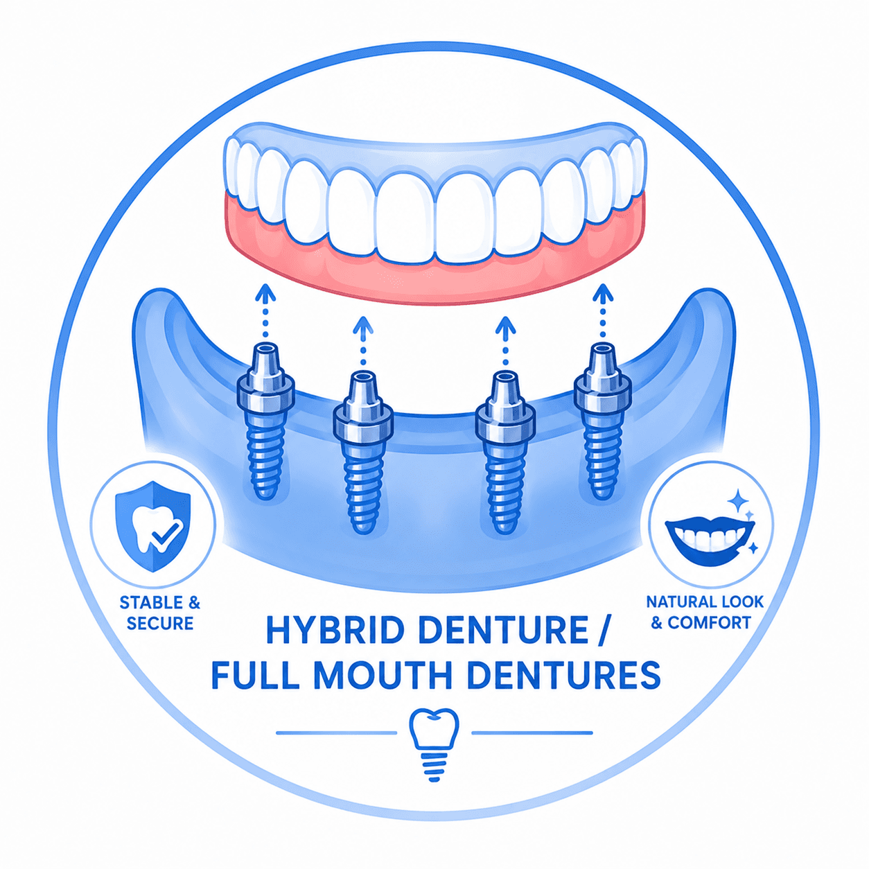 Hybrid Denture/ Full mouth Dentures