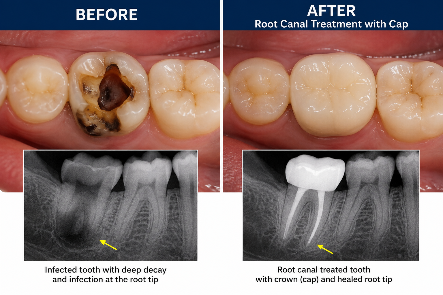 Microscopic Root Canal Therapy Before and After